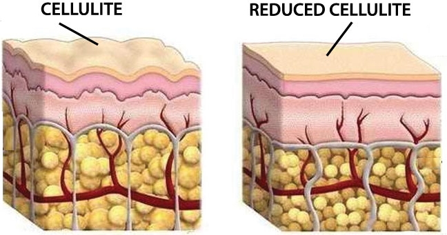 cellulite reduction